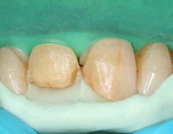 An extremely thin layer of highly translucent enamel composite (G-ænial TE) was placed,