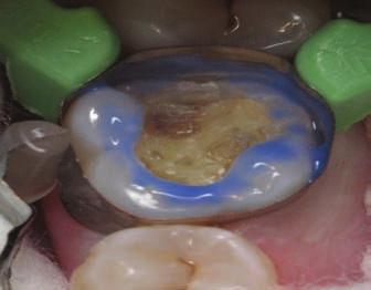 cavity floor and distal enamel margin and