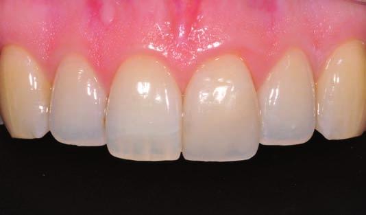 match the optical properties of posterior teeth.