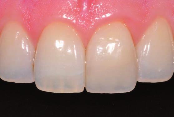 ANTERIOR Beautiful natural high gloss restorations Optimised handling With G-ænial ANTERIOR you gain total control over your results with its smooth, non-sticky