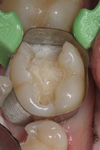 5 G-ænial POSTERIOR has two outside enamel shades P-JE and P-IE.
