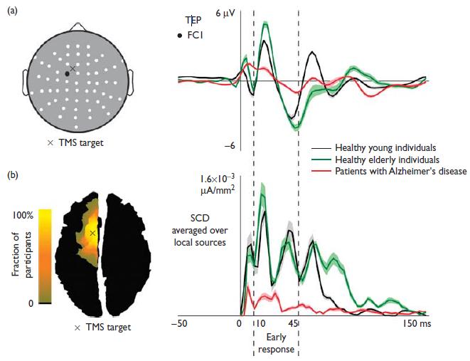 Decreased connectivity in AD Patients with AD and MCI also have decreased frontoparietal EEG connectivity, particularly in the alpha band Babiloni