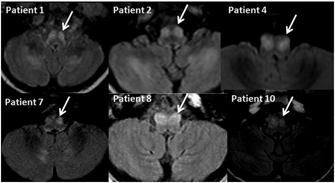 Inferior Olivary Nucleus hypertrophy on MRI in Leigh syndrome Figure 1.