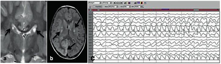 discharges (PLEDS) from (R) posterior leads corresponding to the stroke like lesion(arrows) (c) Axial FLAIR images during another episode shows a stroke like lesion on (L) temporal region (d) EEG