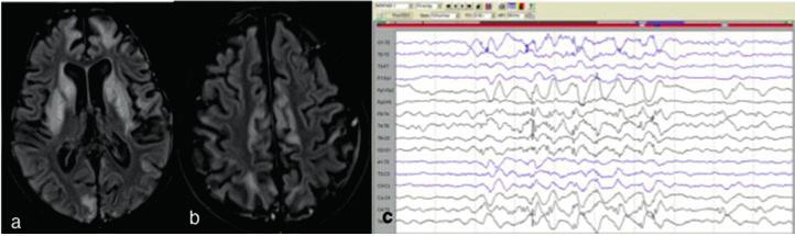(a) Axial T2WI shows bilateral symmetrical signal changes in caudate (b) putamen and (R) parieto-occipital region suggesting a MELAS-Leighs overlap syndrome.