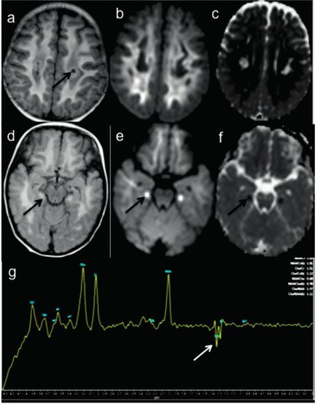 Chapter 5 Fig.4 MRI brain in a 2 year old girl with homozygous NDUFV1 variation.