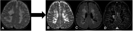 Mitochondrial Leukoencephalopathies Fig.1: MRI Brain in a 2-year-old child with Mitochondrial leukoencephalopathy and mutations in IBA57 (Patient 14).