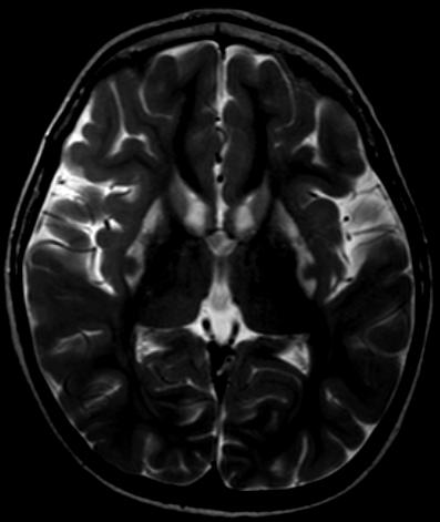 m1t) in LYRM7 F. T2W MRI in a 10 year old girl with a homozygous mutation (c.148c>t,p.arg50 Trp) in MPV17 A B Fig.