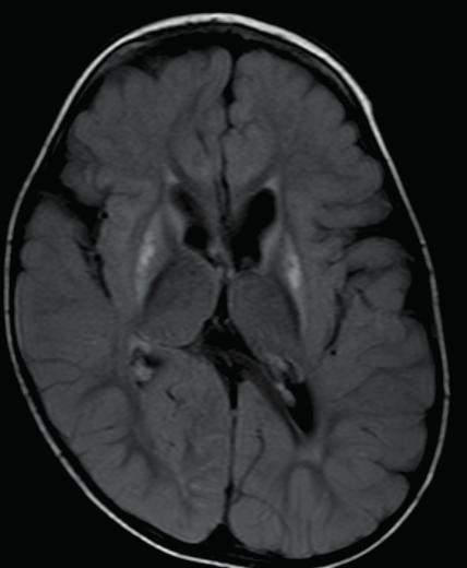 Chapter 1 A B Fig.3 MRI brain in 2 year old boy with Leigh like syndrome, methyl malonic aciduria and deafness with a homozygous mutation in SUCLA2. A.T2W axial view shows bilateral symmetrical signal changes in putamen B.