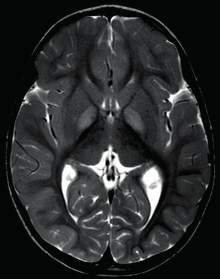 4 MRI brain in a 2 year old boy with paroxysmal exercise induced dystonia, leigh like syndrome and compound heterozygous mutations in the ECHS1 gene.