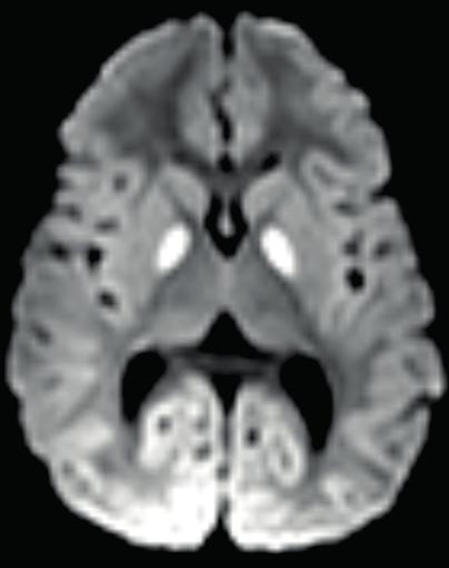 A:T2W axial image showing bilateral symmetrical signal changes in globus pallidi.