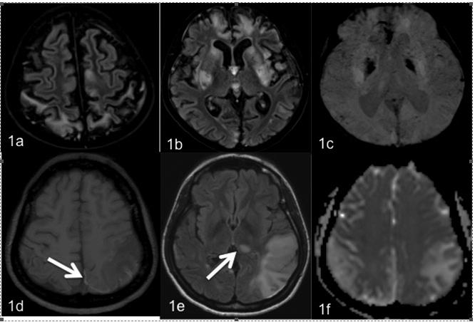 Magnetic Resonance Imaging findings in Mitochondrial disorders Fig 1 Spectrum of MRI findings in patients with m.