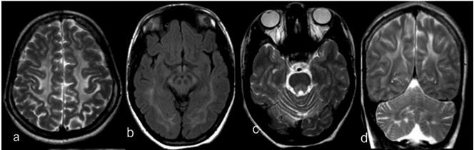 demonstrating the selective lateral and dorsal column signal changes. Fig.4.4a d Leukoencephalopathy in KSS(Patient21).
