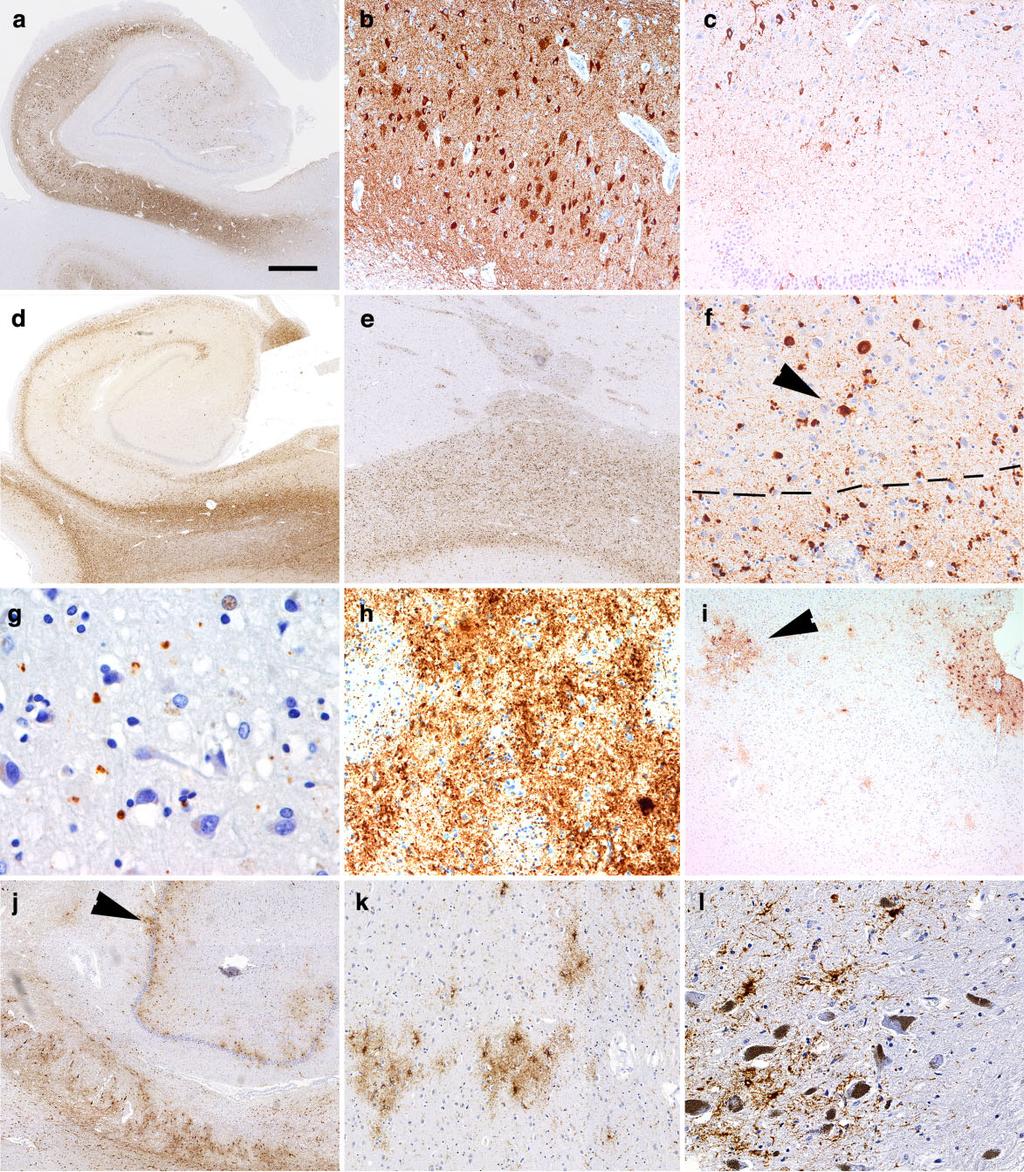 Neuropathology of tauopathies 13 Figure 4. Histopathological findings in tauopathies (II).
