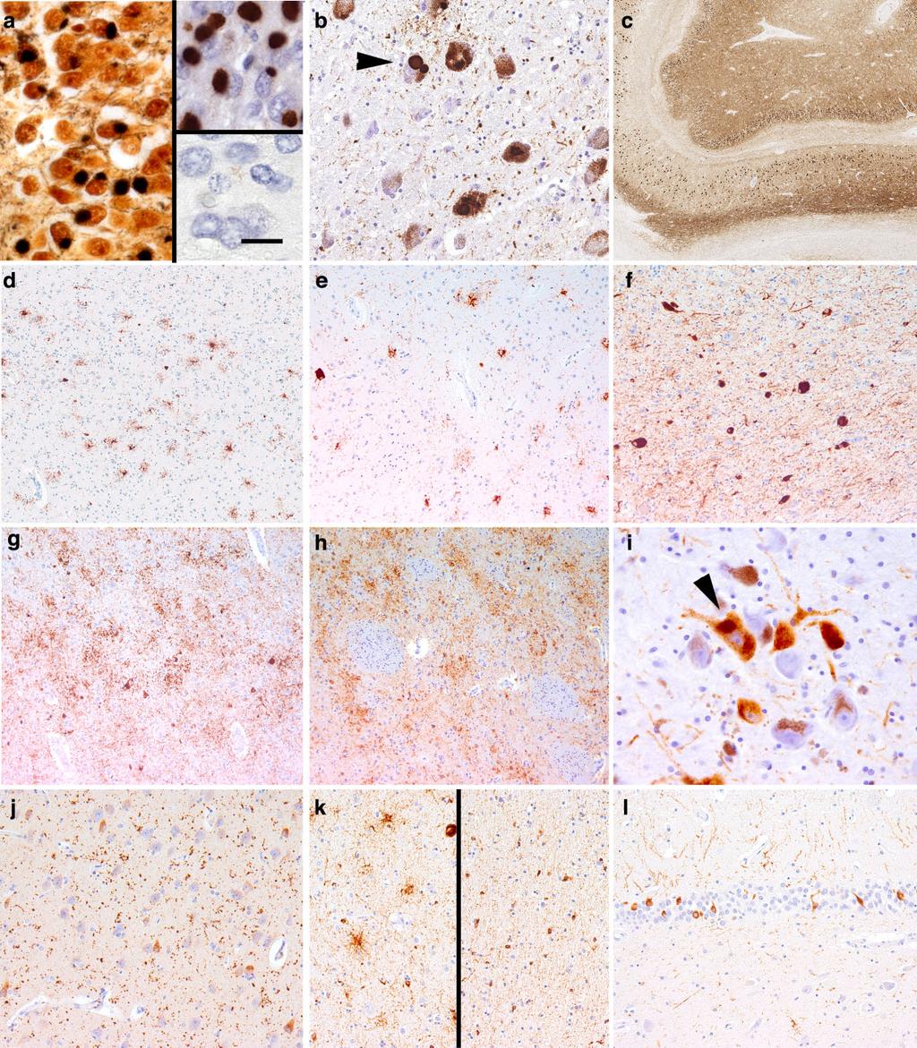 Neuropathology of tauopathies 11 Figure 3. Histopathological findings in tauopathies (I).