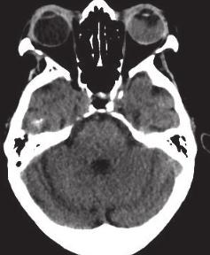 retinoblastoma.