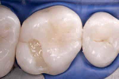 Case 4 4torative treatment The following clinical case study describes the restorative treatment performed following excavation of hidden ssure caries in the distal pits of a maxillary molar and a