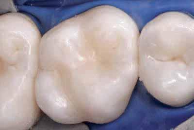 The resulting distal cavity re ects the extent of the severely undermining caries.