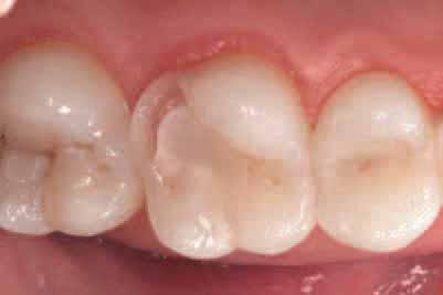 Case 1 This case study focuses on the restoration of a maxillary molar.