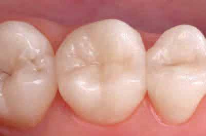 of occlusal surface