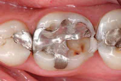 Case 2 The following clinical case highlights the replacement of an inadequate amalgam restoration