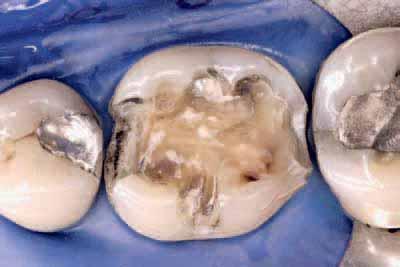 2t Following caries removal and preparation of the cavity margins, mesially and distally, contoured