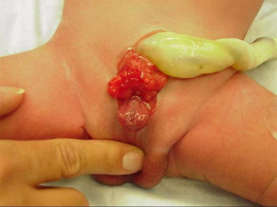 -Associated with bladder exstrophy http://newborns.stanford.