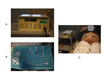 5) Figure 5: A) Current generator, PhysionizerÇ. B) Specifically designed catheter with the active electrode. C) EMDA treatment in course.