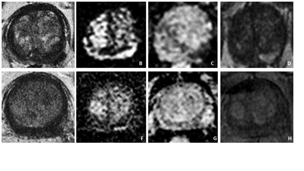 ADC map Patient underwent 3T prostate multiparametric MRI, 6 weeks