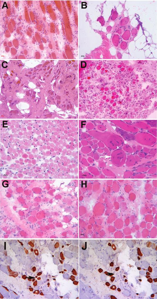 a-dystroglycan Glycosylation in Dystroglycanopathies Jimenez-Mallebrera et al Figure 1. Illustrative images of the spectrum of pathology seen in this cohort of patients. Hematoxylin and eosin: A. P1.
