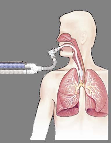 Respiratory Humidification Normal airway humidification is bypassed or compromised during