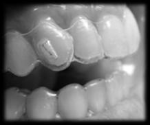 Managing invisalign Aligner Tracking Issues Tips and Techniques for