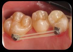 need any attachments Before After 2mm of mesial