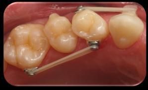 challenging tooth movements Buttons and elastics