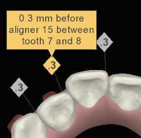 lateral IPR before aligner 15 IPR