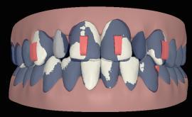 2. Multiple tooth