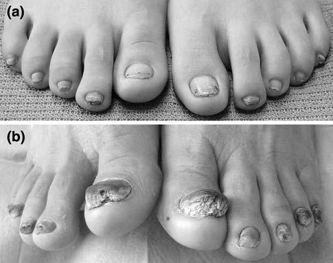 2 a Dystrophy of all toenails with subungual hyperkeratosis in the daughter b Marked dystrophy avecting all toenails in the father being most prominent in the axillae.