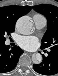 85 year old male Acute Type A Dissection Mild Aortic
