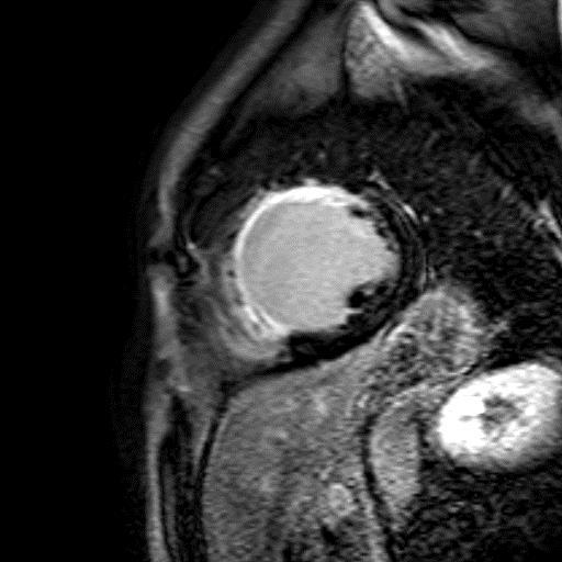 MR-viability Approach Contrast-enhanced MRI Minimal scar tissue (< 25% transmurality) Recovery of dysfunctional myocardium is likely to occur Scar tissue >