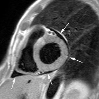Cardiac MRI, the Advantages Non-invasive No radiation Excellent signal