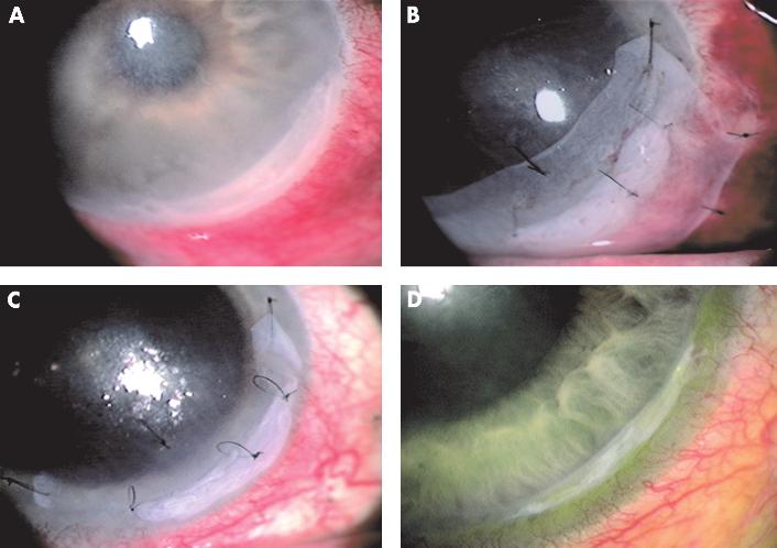 Ulcerating HSK improved after AMT 1217 Table 3 Amniotic membrane transplantation (AMT) in seven patients with acute ative and necrotising herpetic keratitis.