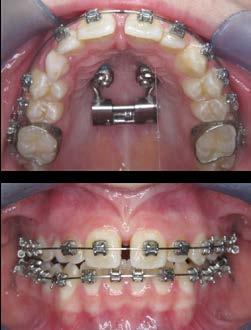 Implants with several types of abutments and connectors allow the construction of versatile and cost-efficient appliances for a large variety of orthodontic applications.