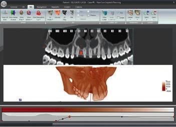 It can simulate the implant placement on 2D and 3D models, identify the mandibular canal, draw panoramics