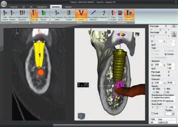 NewTom Implant Planning is used to plan prosthesis implant surgery in a faster, safer and more efficient