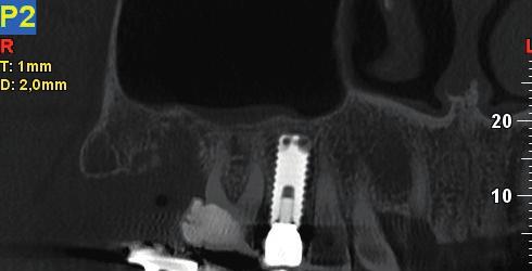 both the implant and the mandibular canal position.