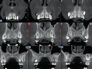 After a single scan, Sagittal and Coronal views can be sectioned