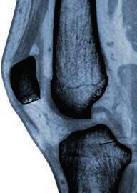 fractures and identifying osseous