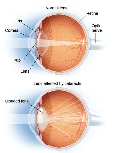 Traditional Cataract Surgery Our eye functions much like a camera.