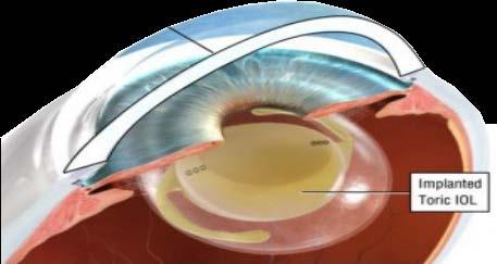 Moderate and higher amounts of astigmatism can be corrected with a Toric lens implant, a lens implant specifically designed to correct astigmatic prescriptions.
