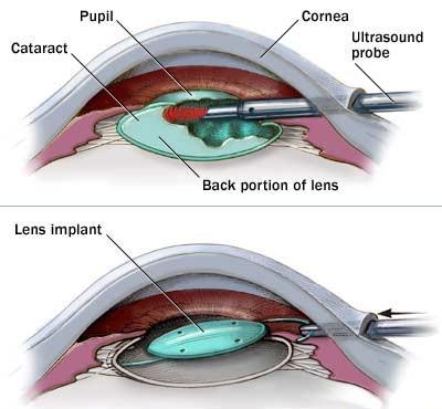 Your vision without glasses usually improves gradually over the first year. An Accommodating IOL is one that can move or change its shape in the eye.